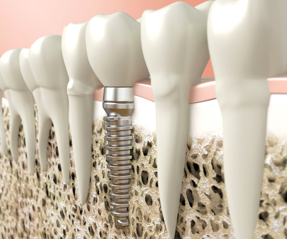 Dental implant cross-section showing titanium screw in jawbone with natural teeth alongside.