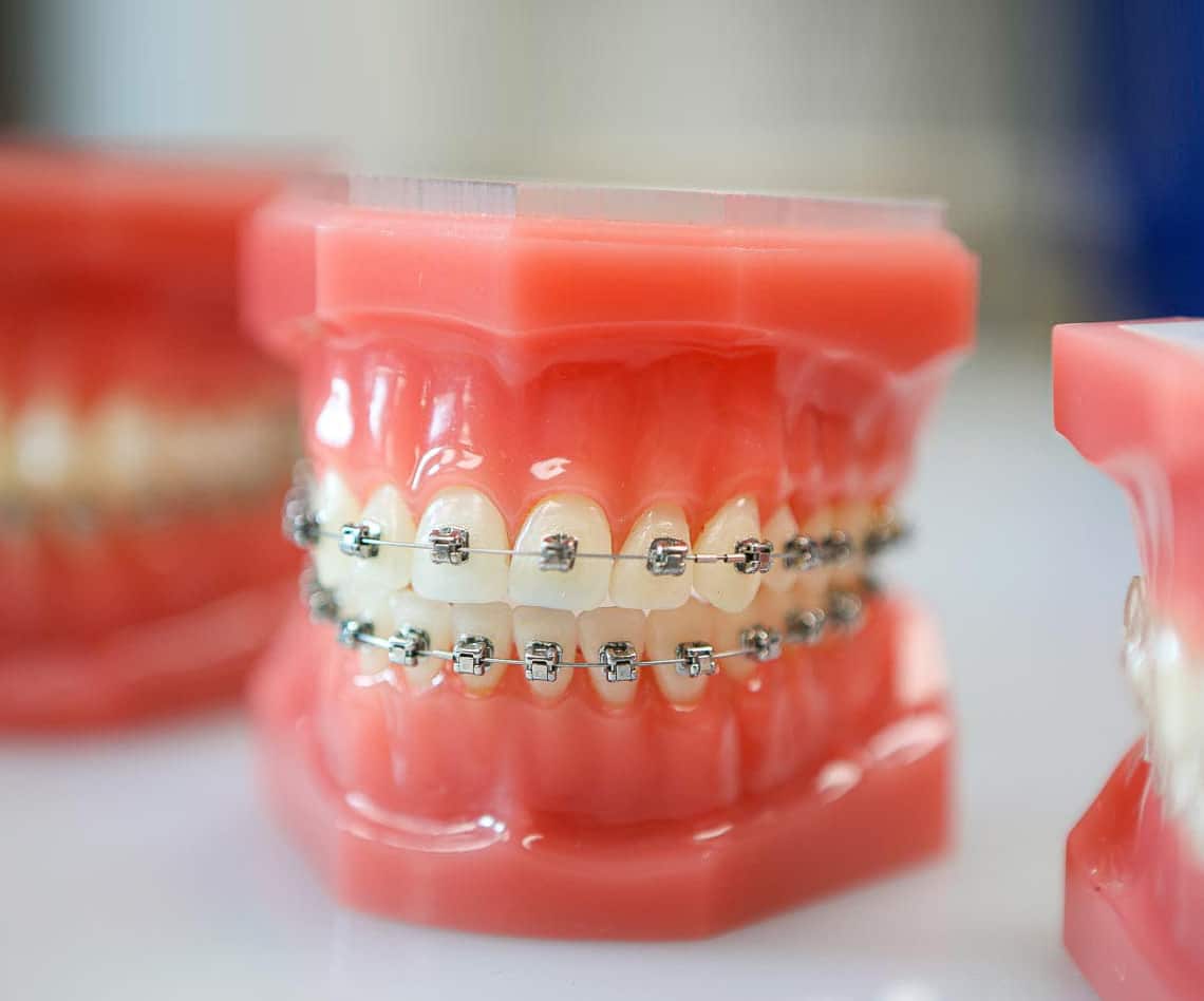 orthodontics braces in Denton for teeth alignment
