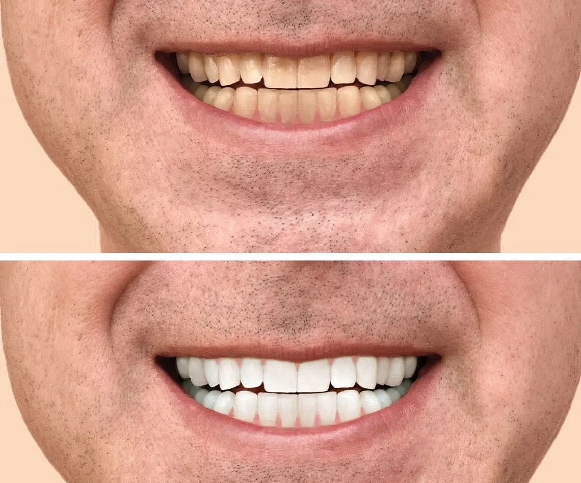 Before and after comparison of teeth whitening results showing improved brightness and shade.
