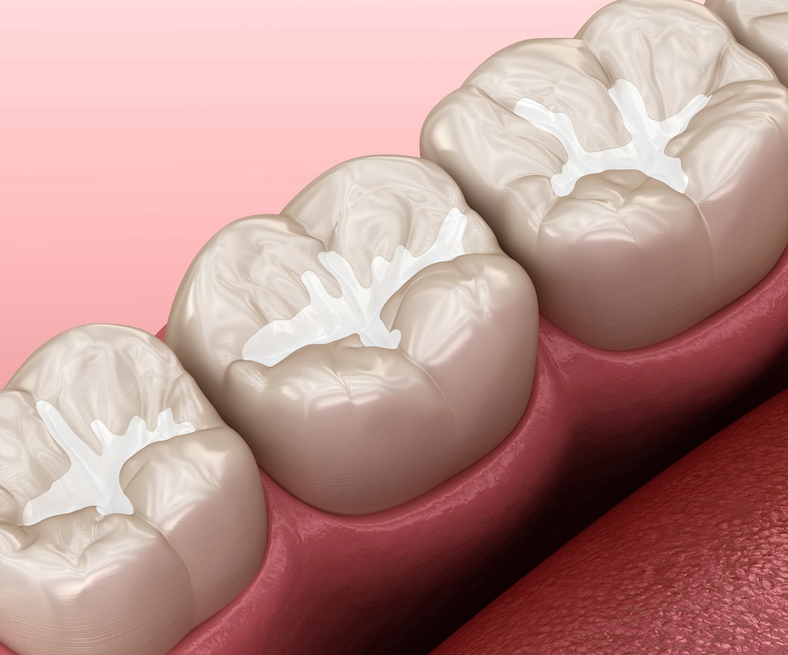 tooth sealants for preventing decay
