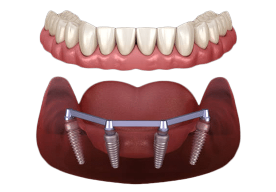 Dental implant prosthetic showing upper teeth crown and lower jaw with four implant posts.