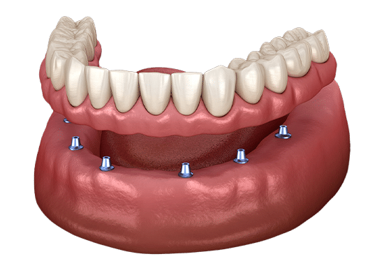 Dental implant diagram showing prosthetic teeth anchored to jawbone with metal implant posts.