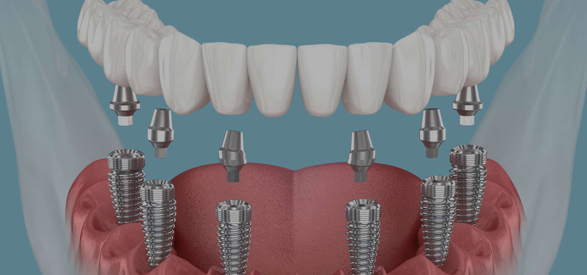 Dental implant diagram showing prosthetic teeth and metal implant posts on gum model.