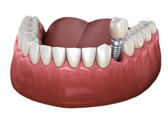Dental implant illustration showing tooth replacement in gum model with prosthetic crown and implant post.