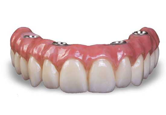Dental prosthetic model showing artificial teeth and pink gum tissue for implant demonstration.