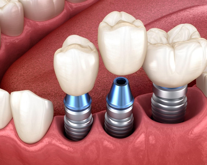 Dental implant components displayed on pink gum model showing abutments and crowns.