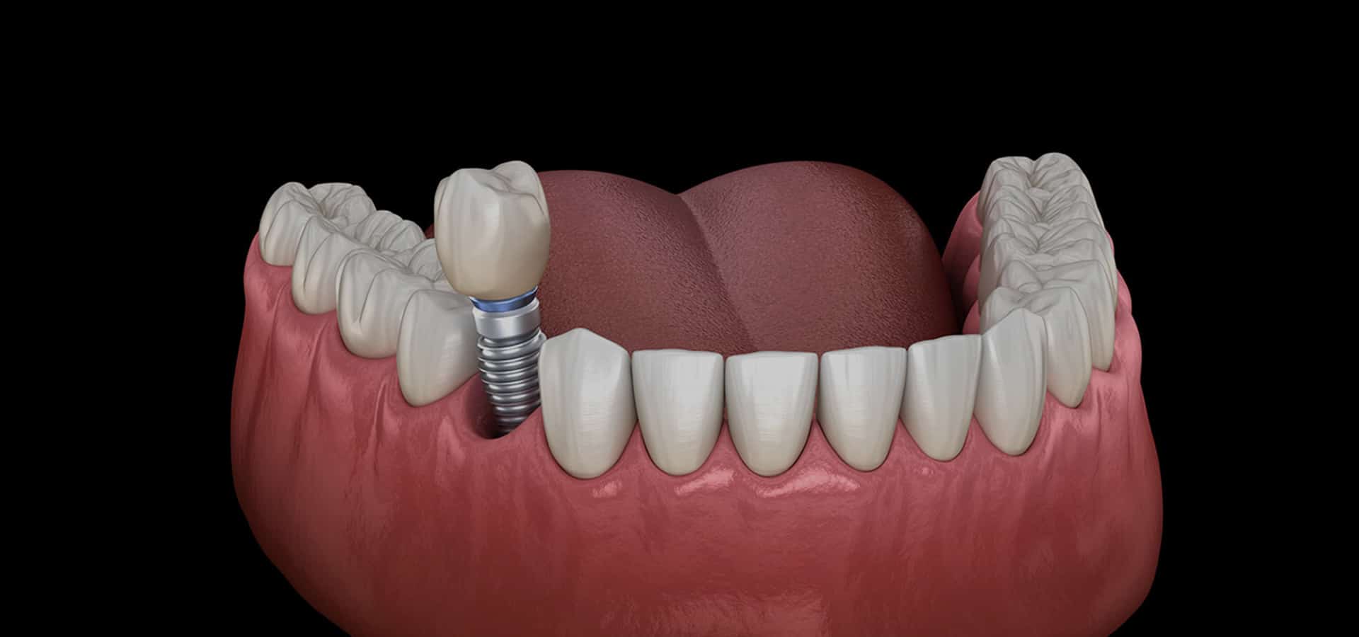 Dental implant model showing tooth replacement in jawbone with crown and natural teeth.