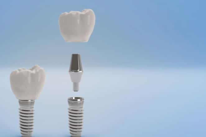 Dental implant components displayed against blue sky background showing crown, abutment, and screw.