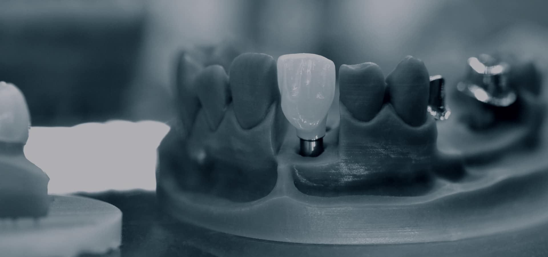 Dental crowns and tooth models displayed on dental model showing restorative dentistry options.