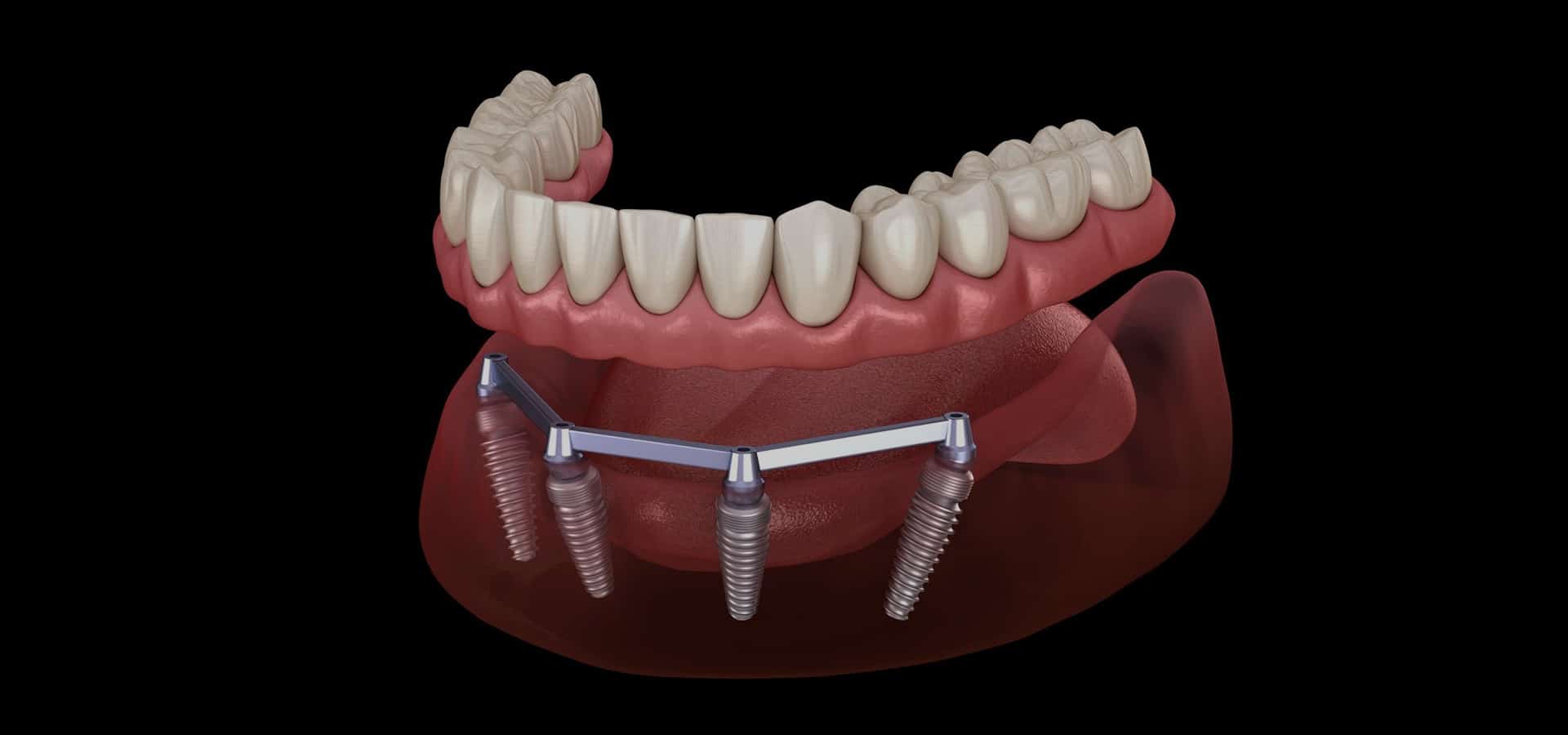 Dental implant model showing prosthetic teeth attached to jawbone structure against dark background.