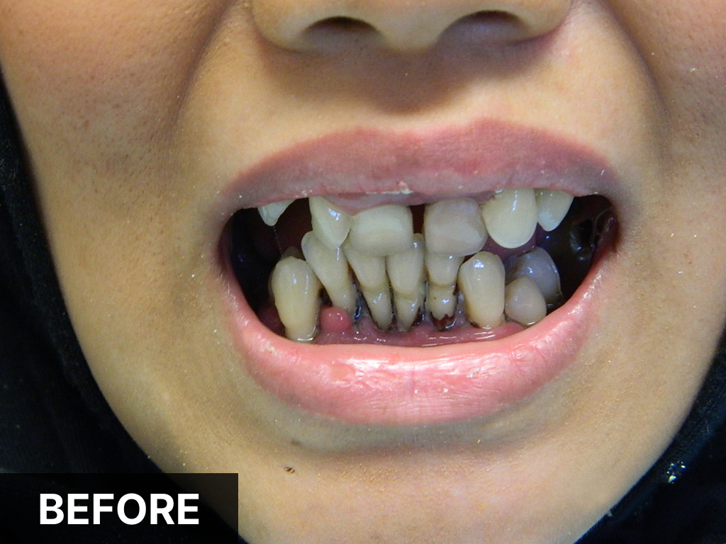 Before dental treatment: close-up of person's smile showing misaligned and discolored teeth