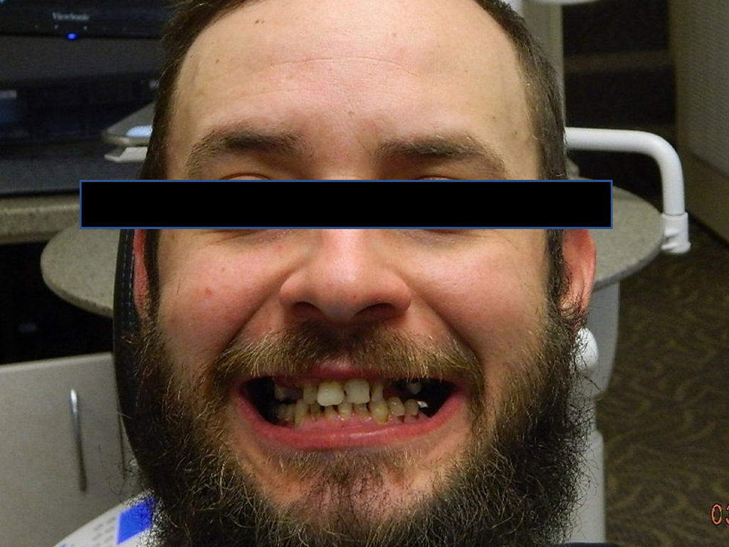 Man smiling at camera in dental office setting, displaying teeth results.
