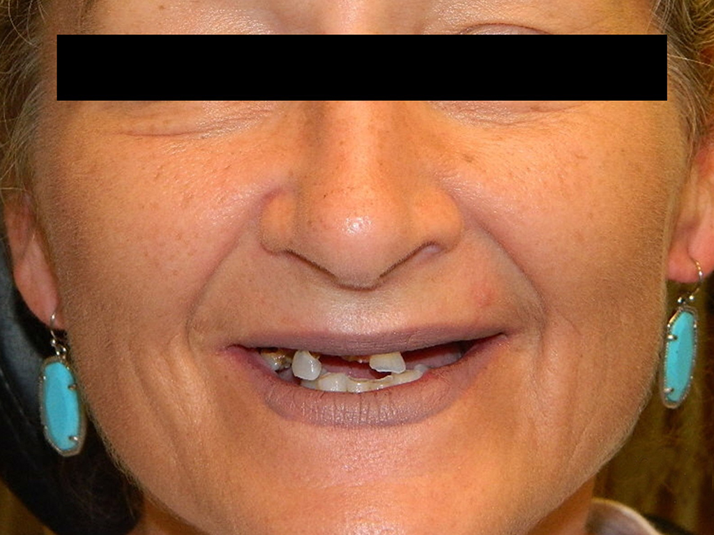Close-up of person smiling, displaying teeth with visible gaps, wearing turquoise earrings indoors.