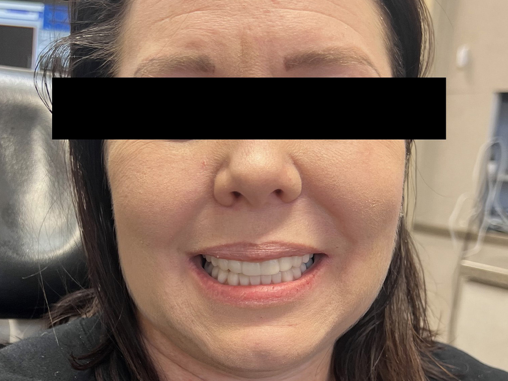 Woman smiling at camera in dental office setting, displaying teeth after treatment.