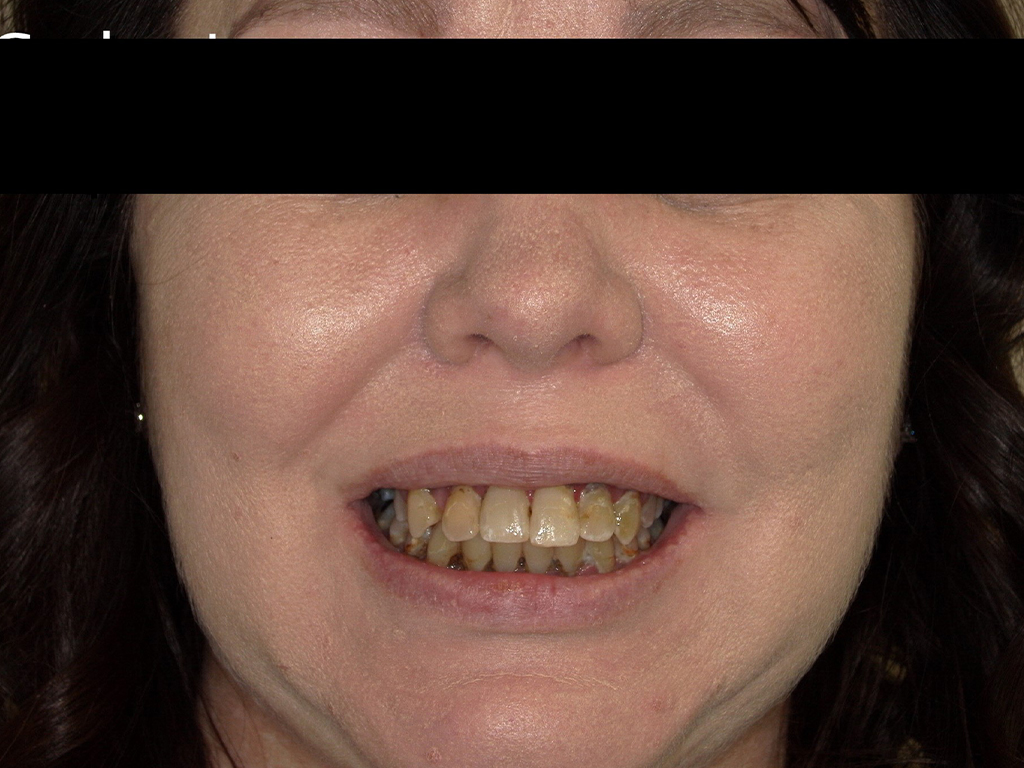 Woman displaying smile with discolored teeth before dental treatment