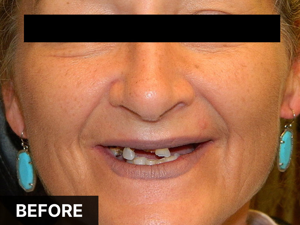 Before dental treatment: closeup of woman's smile showing gaps between teeth and discoloration.