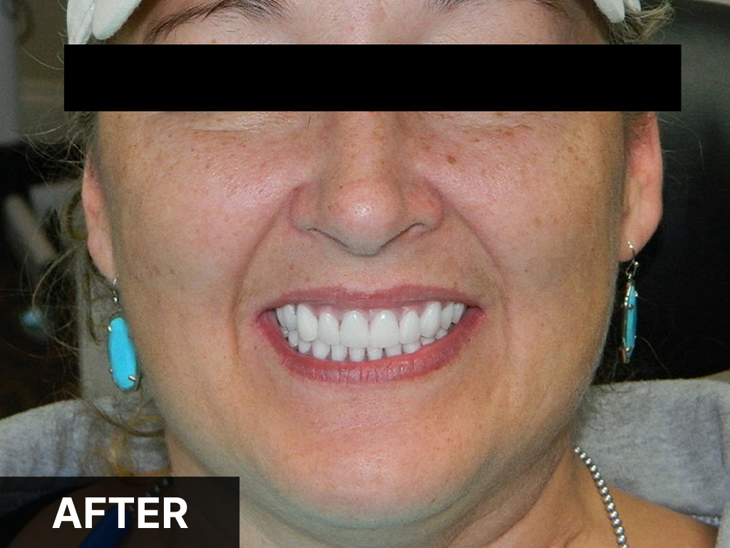 Woman smiling broadly displaying white teeth after dental treatment at Denton Smiles Dentistry.