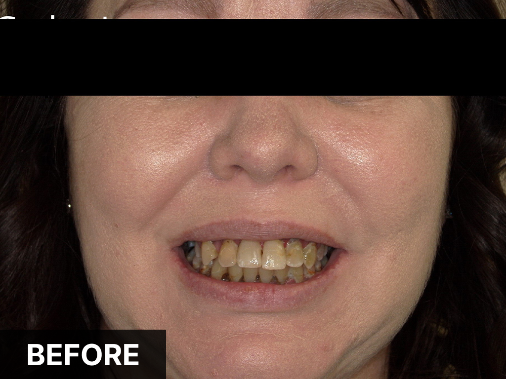 Woman smiling showing discolored teeth before dental treatment at Denton Smiles Dentistry