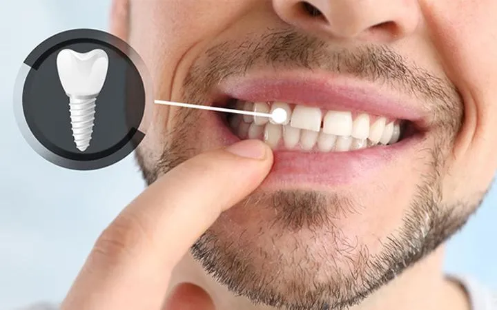Man pointing to teeth with dental implant diagram inset showing tooth restoration procedure.