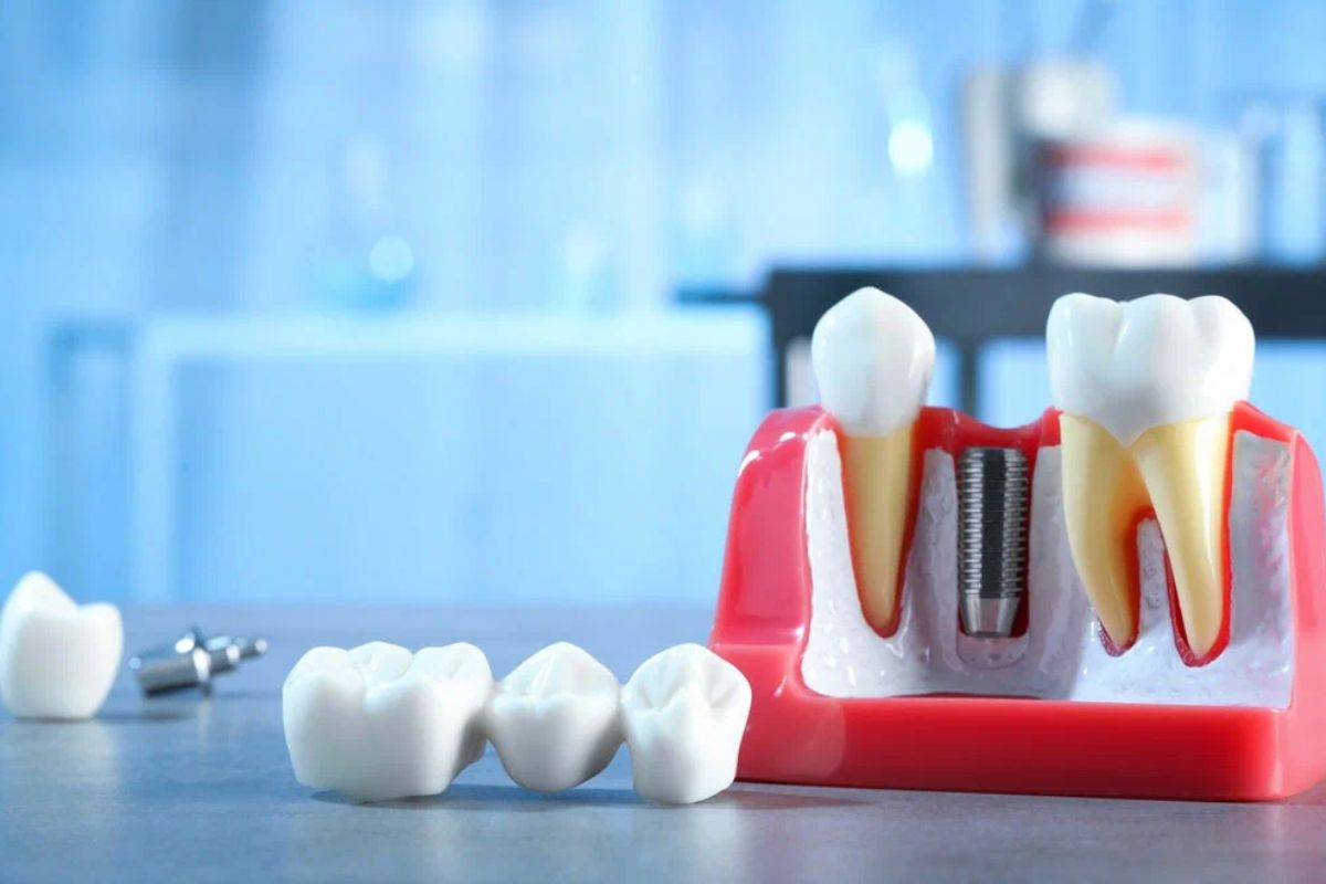 Dental Implants in Denton