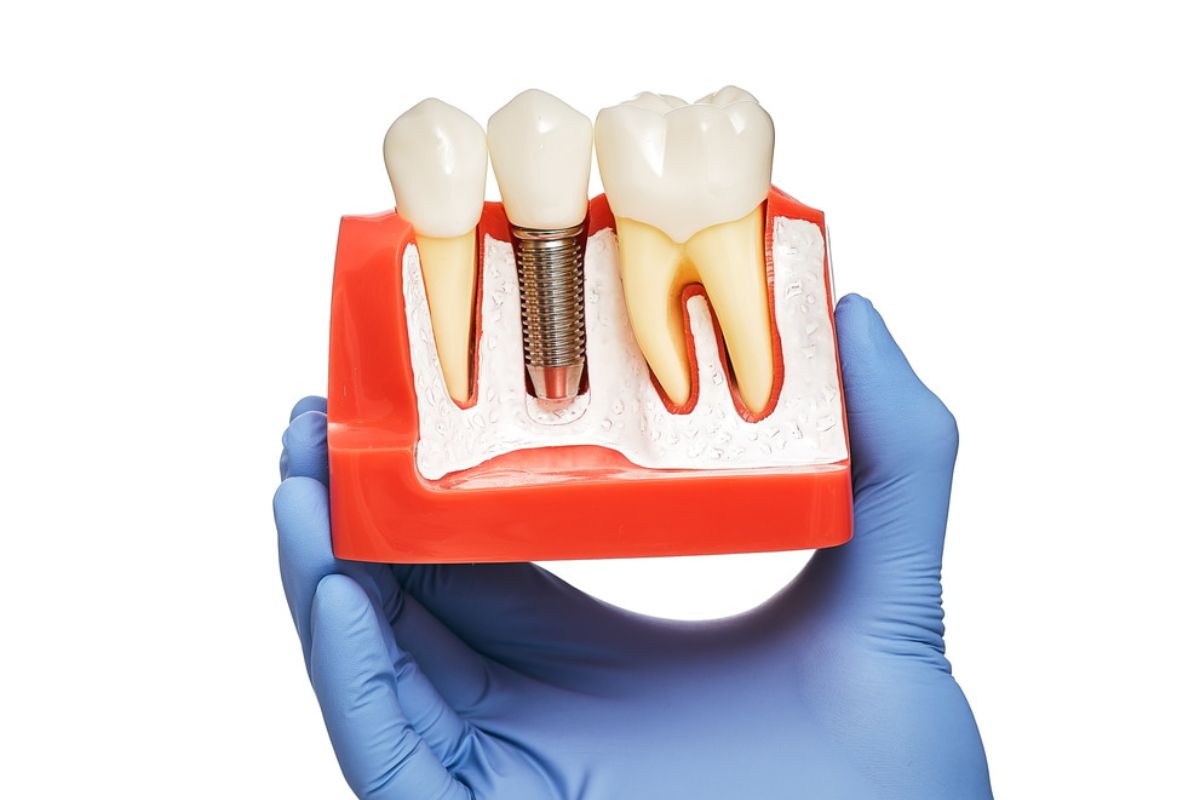 Dental Implants in Denton
