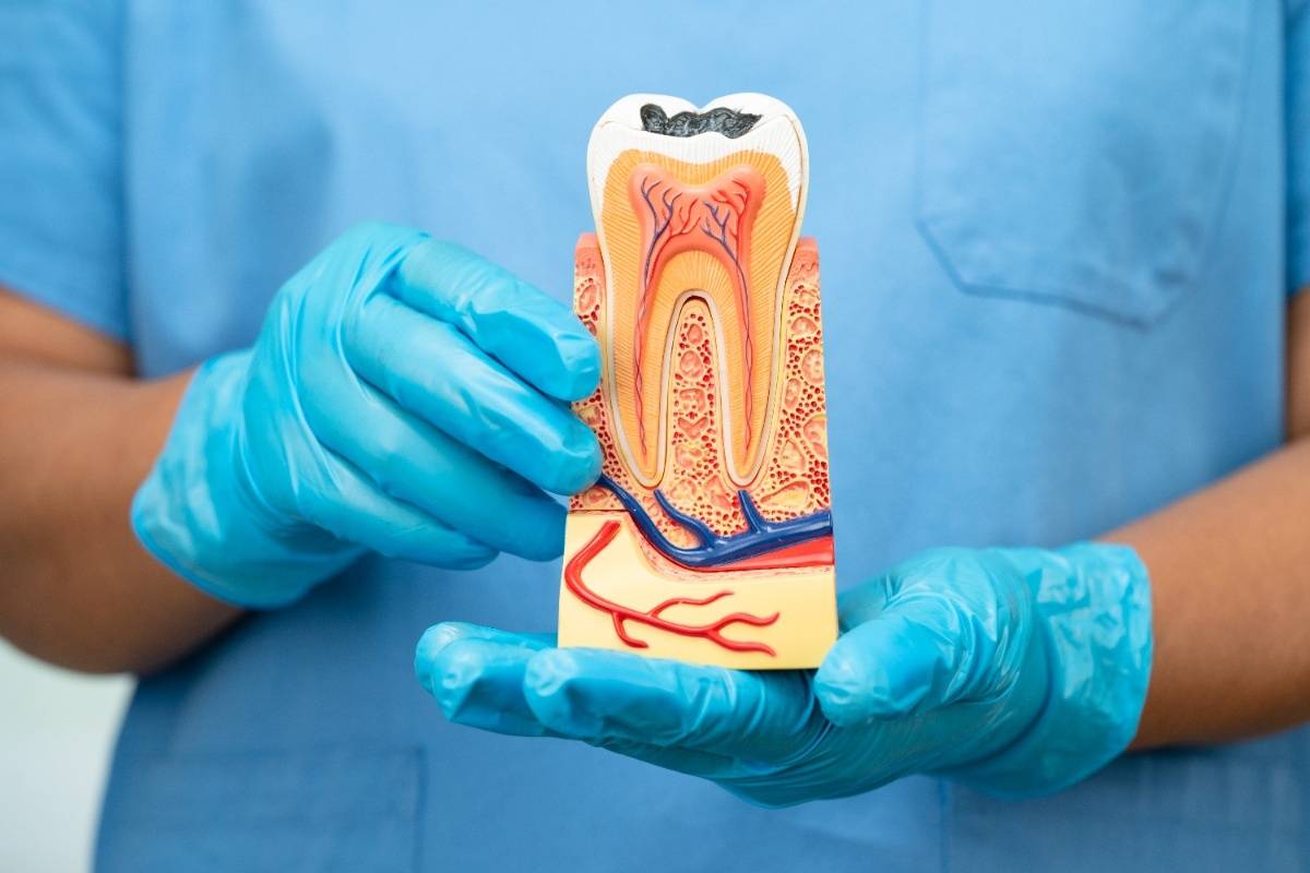 Root Canal Treatment in Denton