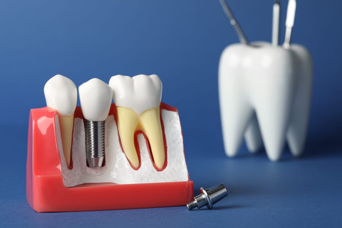 Dental Implants in Denton